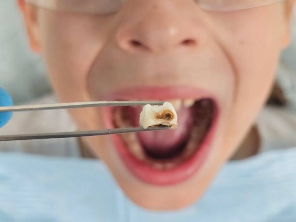 Best Dental Abscess Treatment in Byron, GA