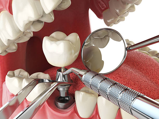 Best Knocked-Out Tooth (Avulsed Tooth) Treatment in Byron, GA